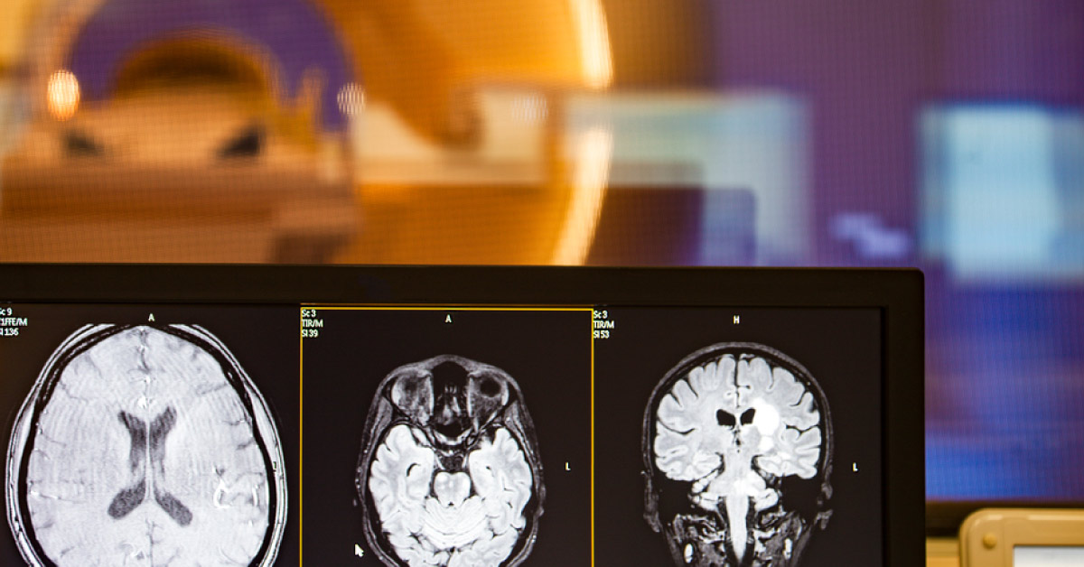 MRI To Use Glucose Instead of Contrasting Agent For Tumors