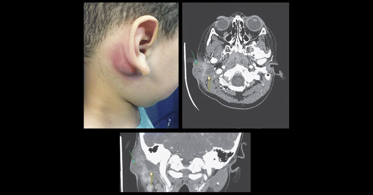 What Is The Reason Of Pain And Swelling Of Ear?
