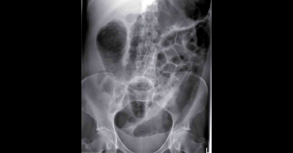 Abdominal Pain And Diarrhea In A Young Woman