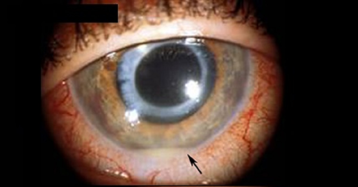 Red Eye, A Case Study To Resolve