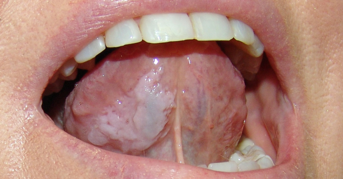 Identify This Non Malignant Oral Condition