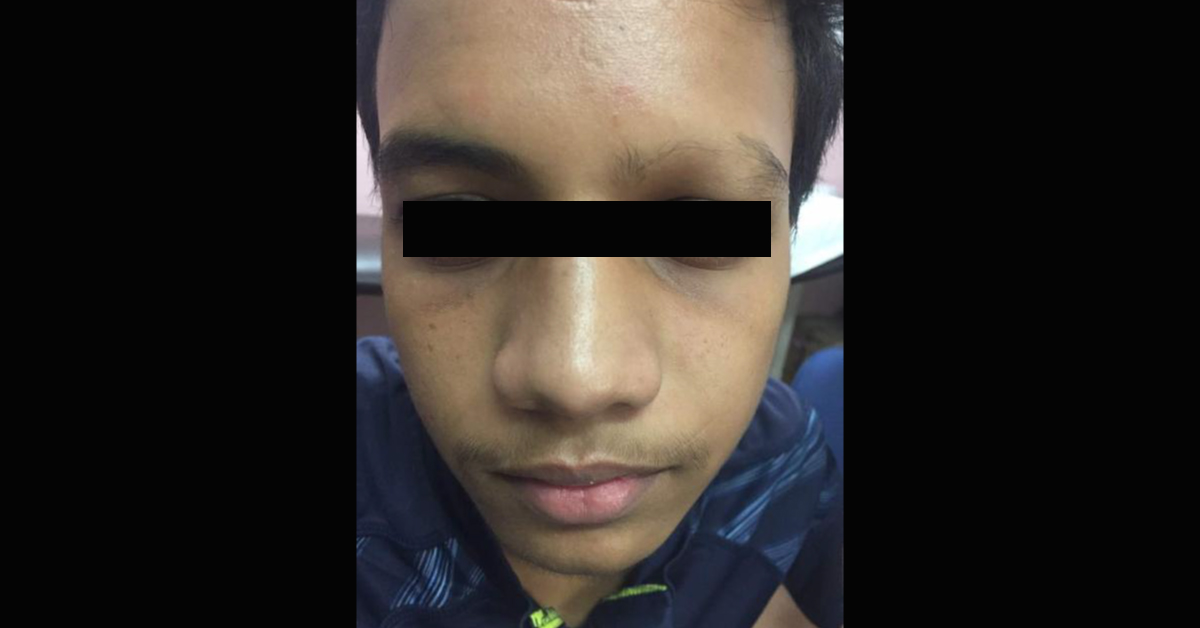 Young Boy Developed Alopecia Areata