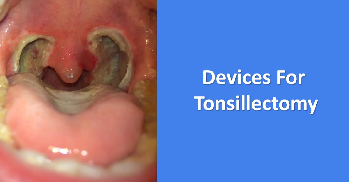 Medical Devices For Tonsillectomy