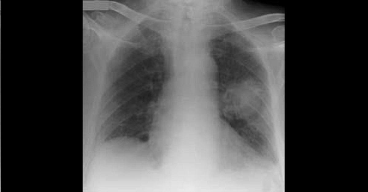 Cough And Weight Loss In A Woman