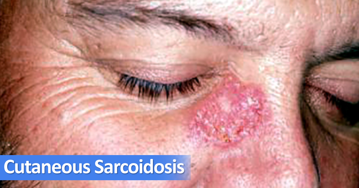 Conventional Management Strategies For Cutaneous Sarcoidosis