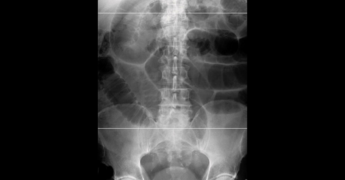 A Case Of Severe Abdominal Pain And Vomiting