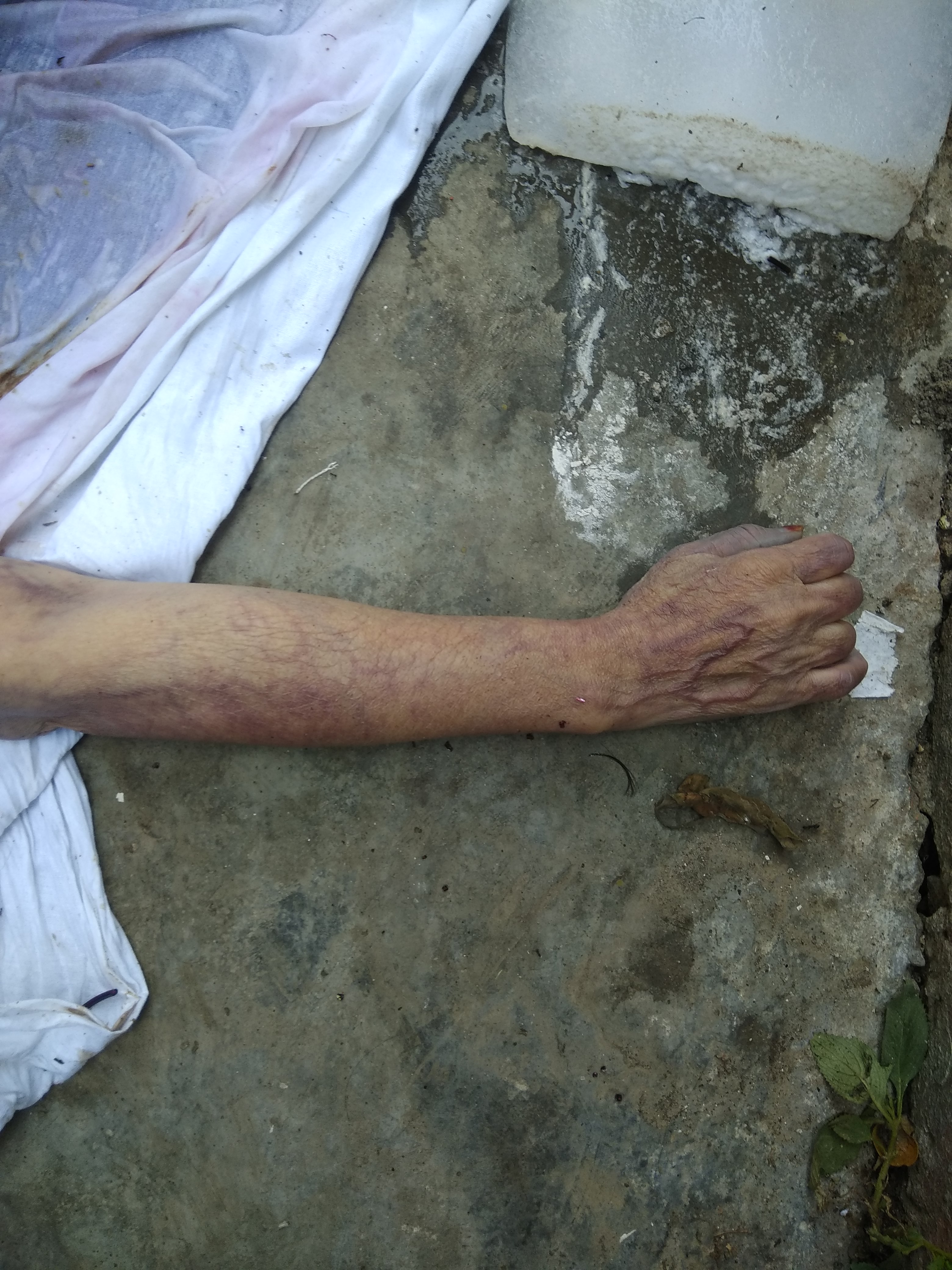 Bluish Streaky Mark Of Veins In A Dead Body