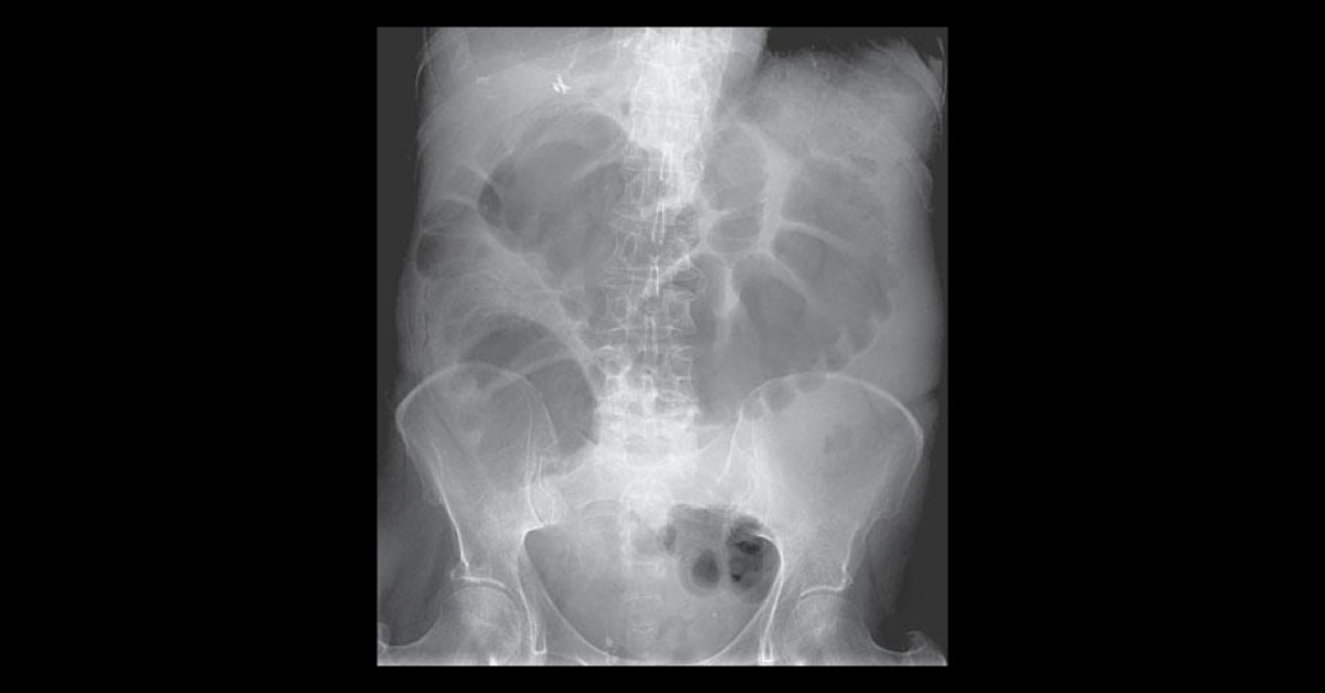 Abdominal Distension In A Woman With Ovarian Cancer