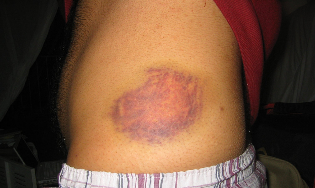 Stabbing Irritation In Waist Area