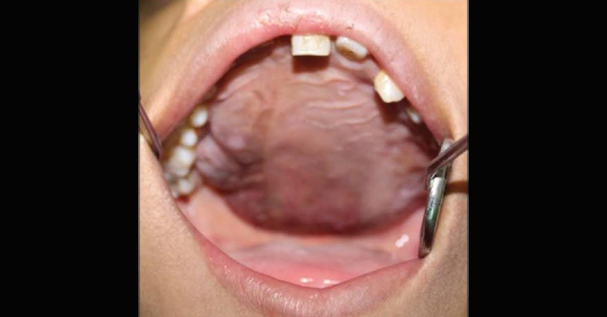 Diagnosis For Swelling On Left Side Of the Face