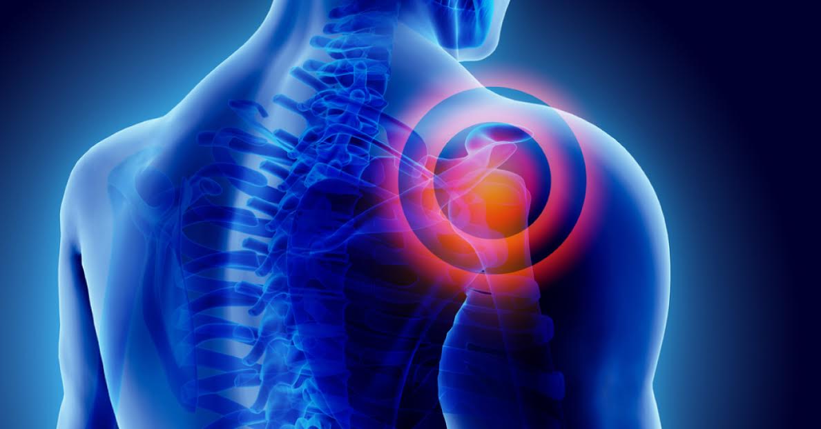 Subacromial Impingement Syndrome, An Insight