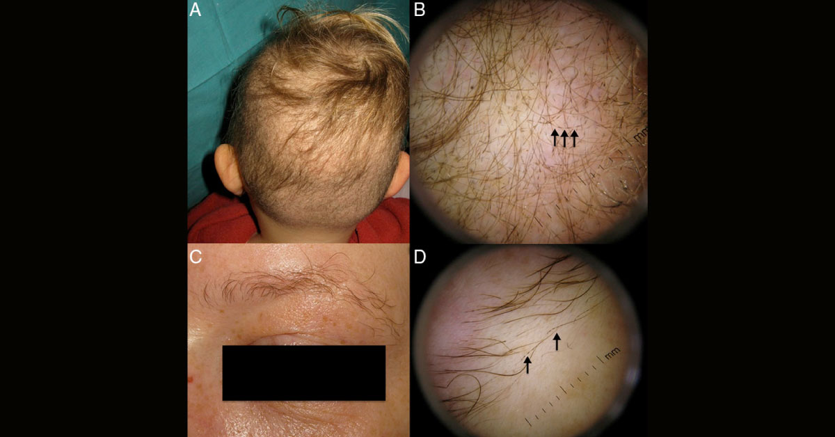 Identify This Rare Dermatological Condition