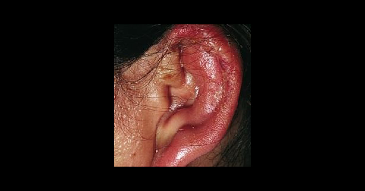Erythema And Swelling Of Ear