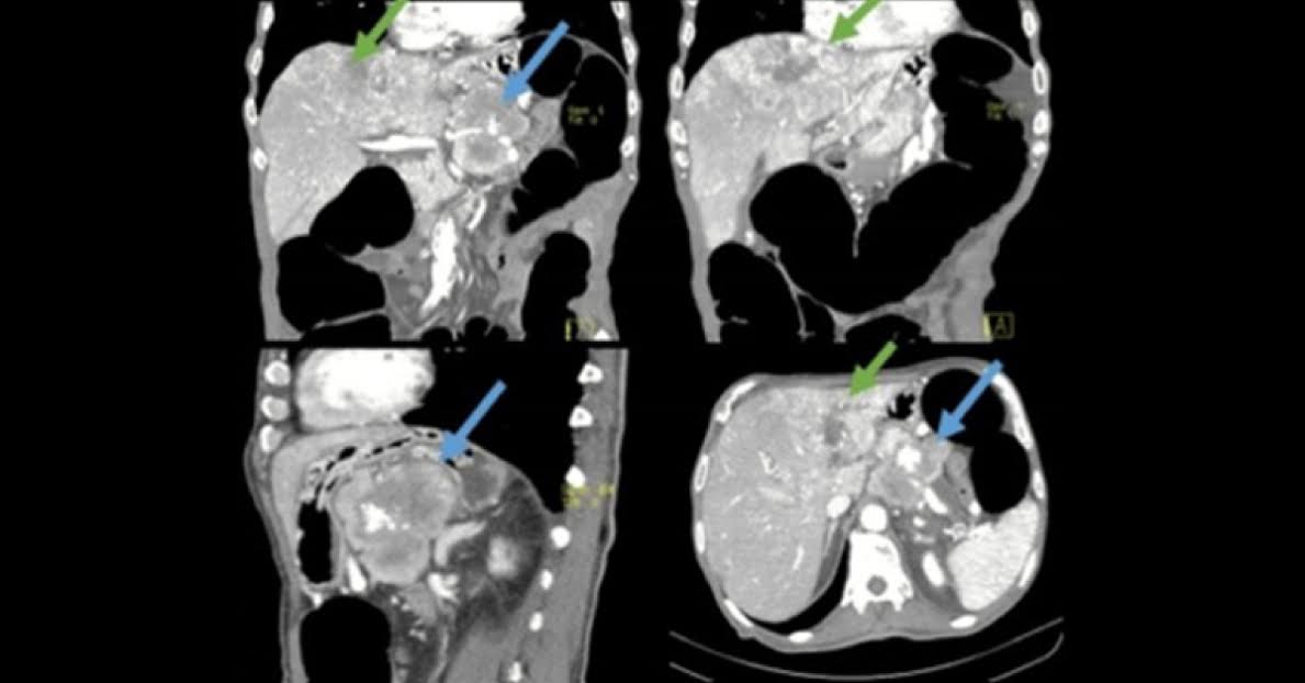 What Does Abdominal CT Indicate