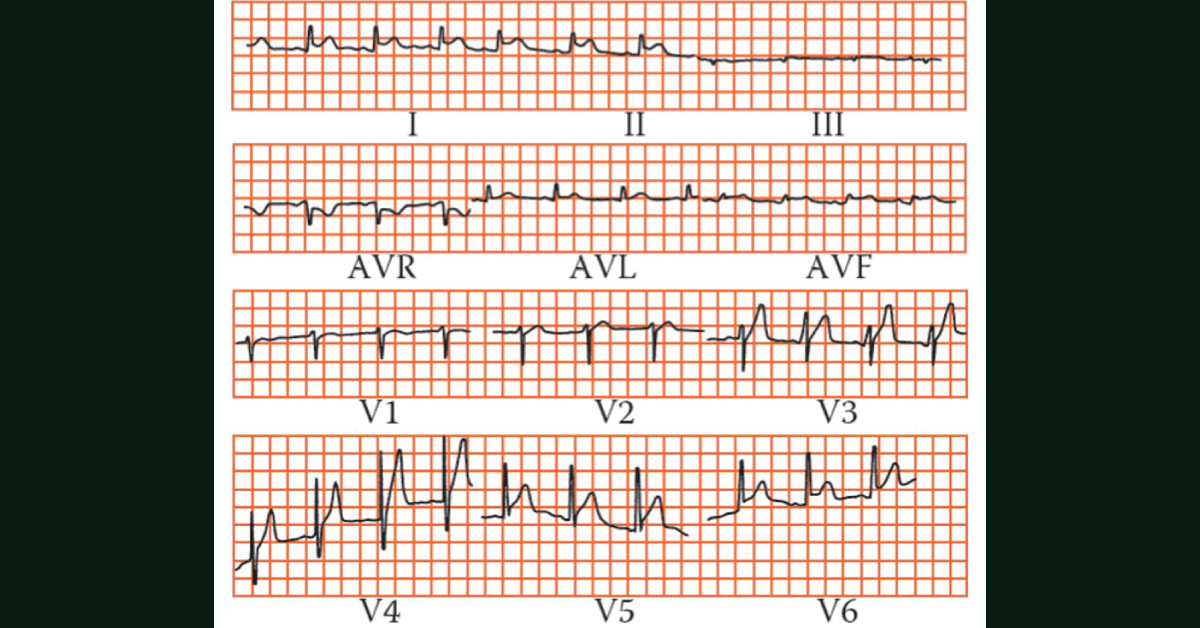 What’s The Diagnosis Of His Chest Pain?