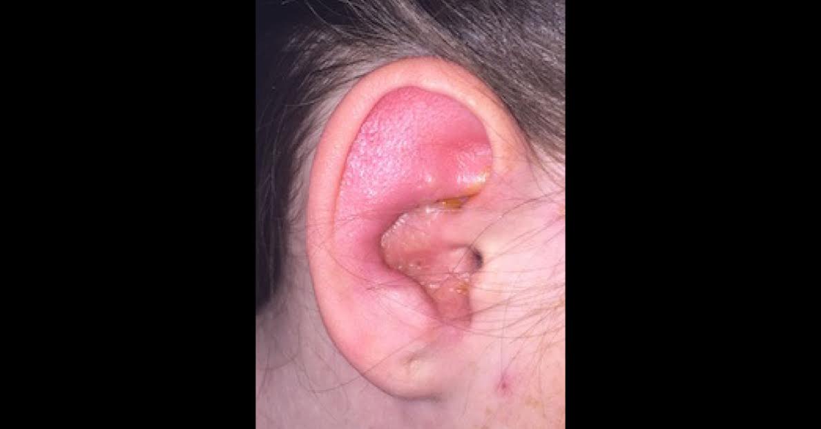 Burning Sensation Over Right Side Of Face