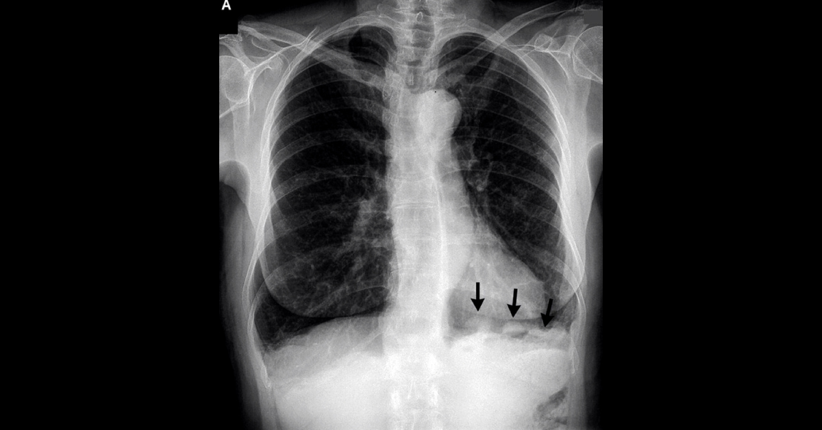 Appearance Of Several Pleural Nodules
