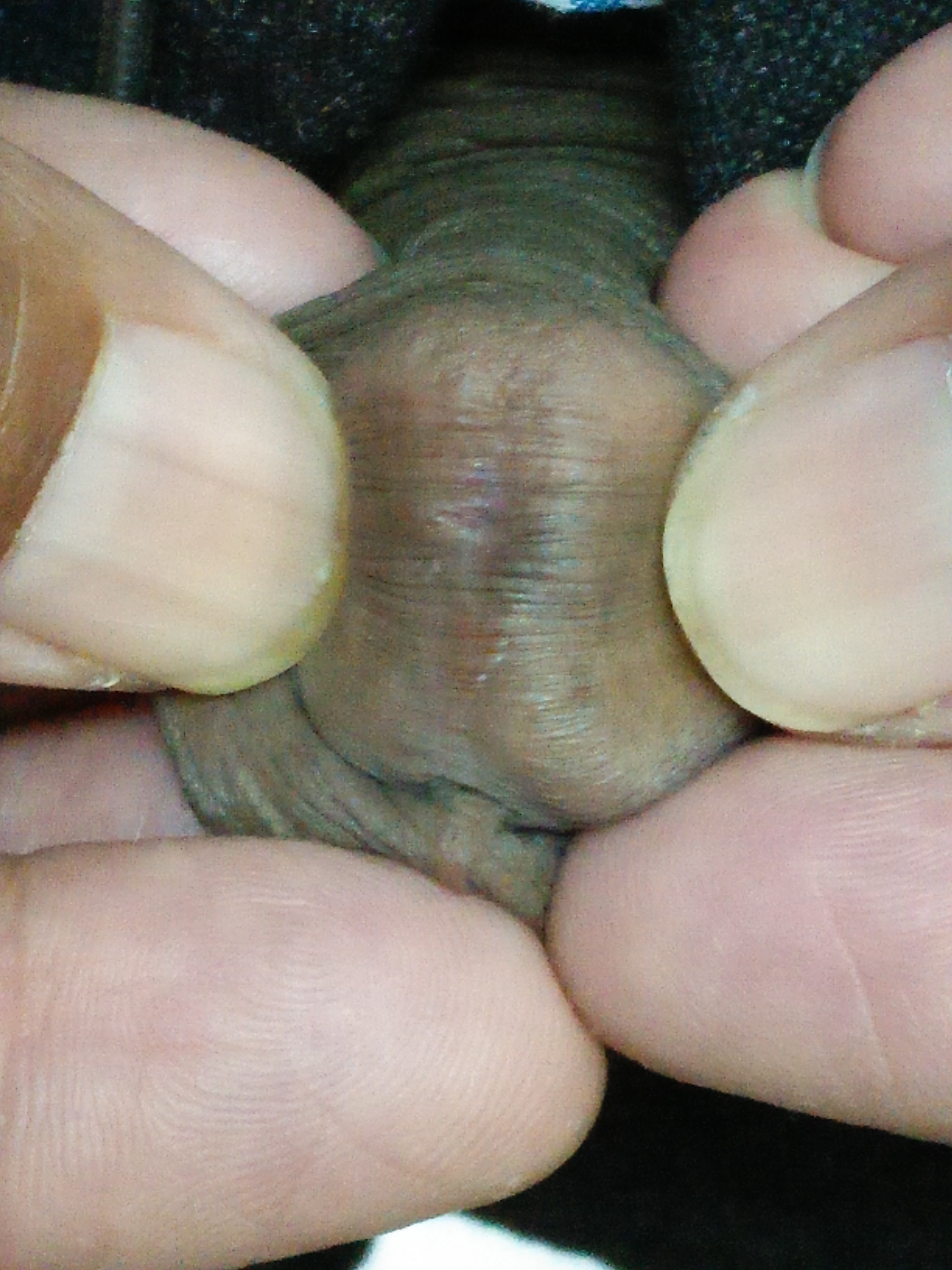 What are the causes of recurrent urethral meatal stenosis ?