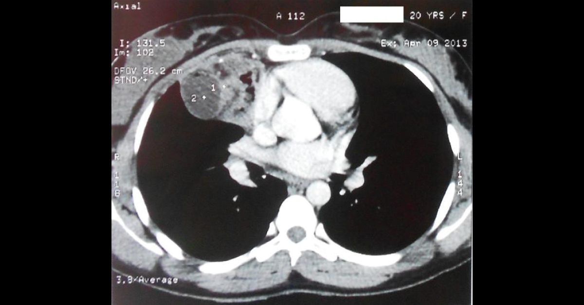 Excision Of Benign Mature Anterior Mediastinal Teratoma Through Trap Door Incision