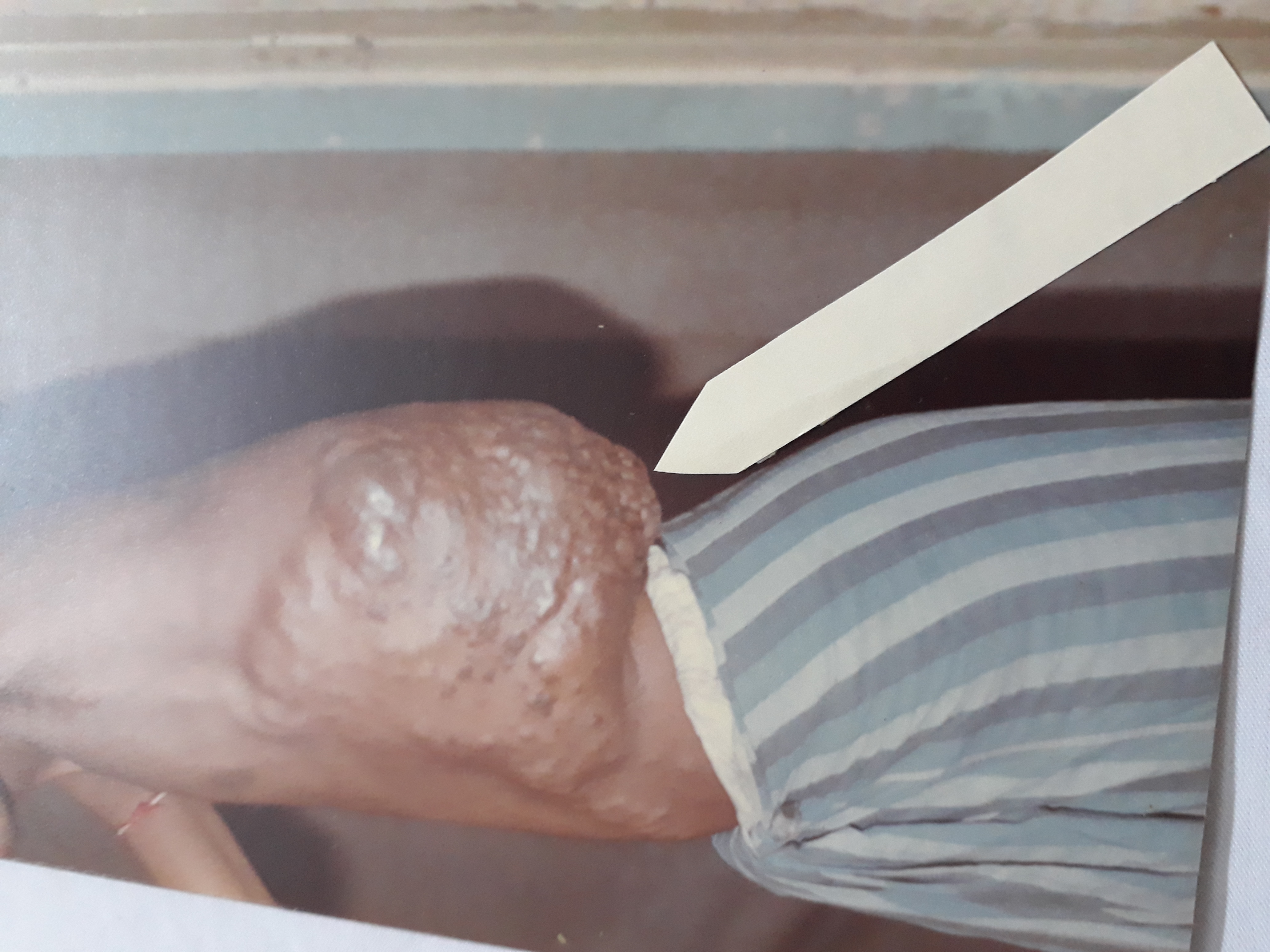 Removal Of Large Haemangioma From Left Side Of Chest Wall In 2002