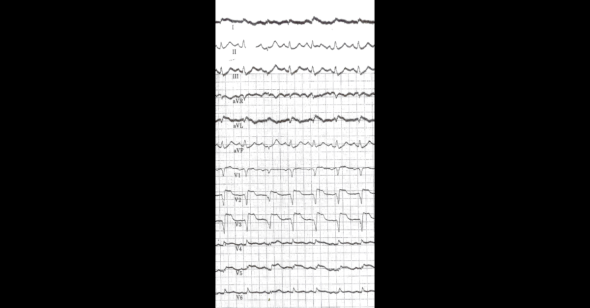 Identify This Cardiac Condition