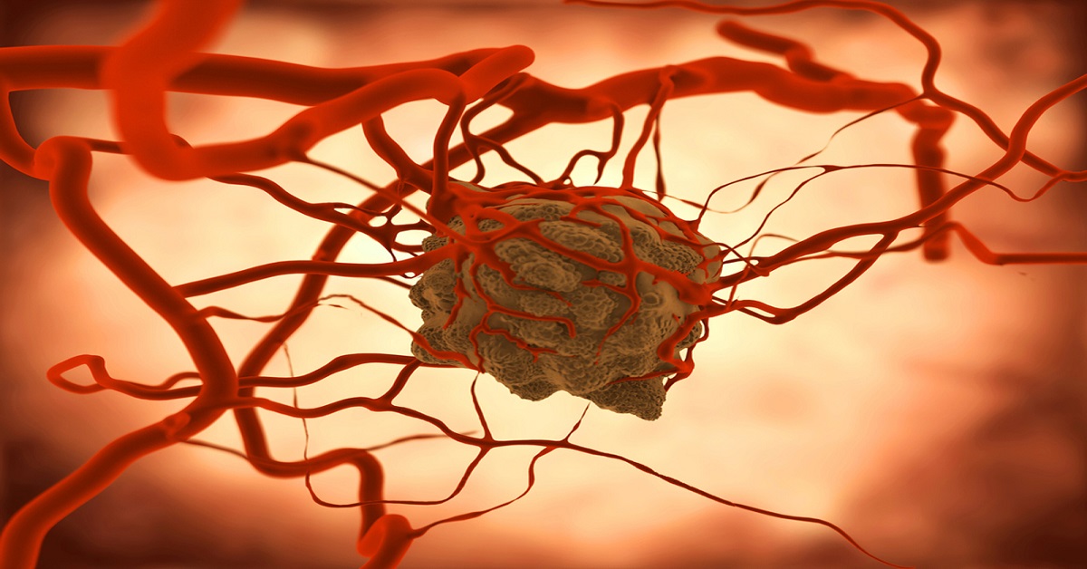 Case Of Poor Prognosis With Breast Cancer
