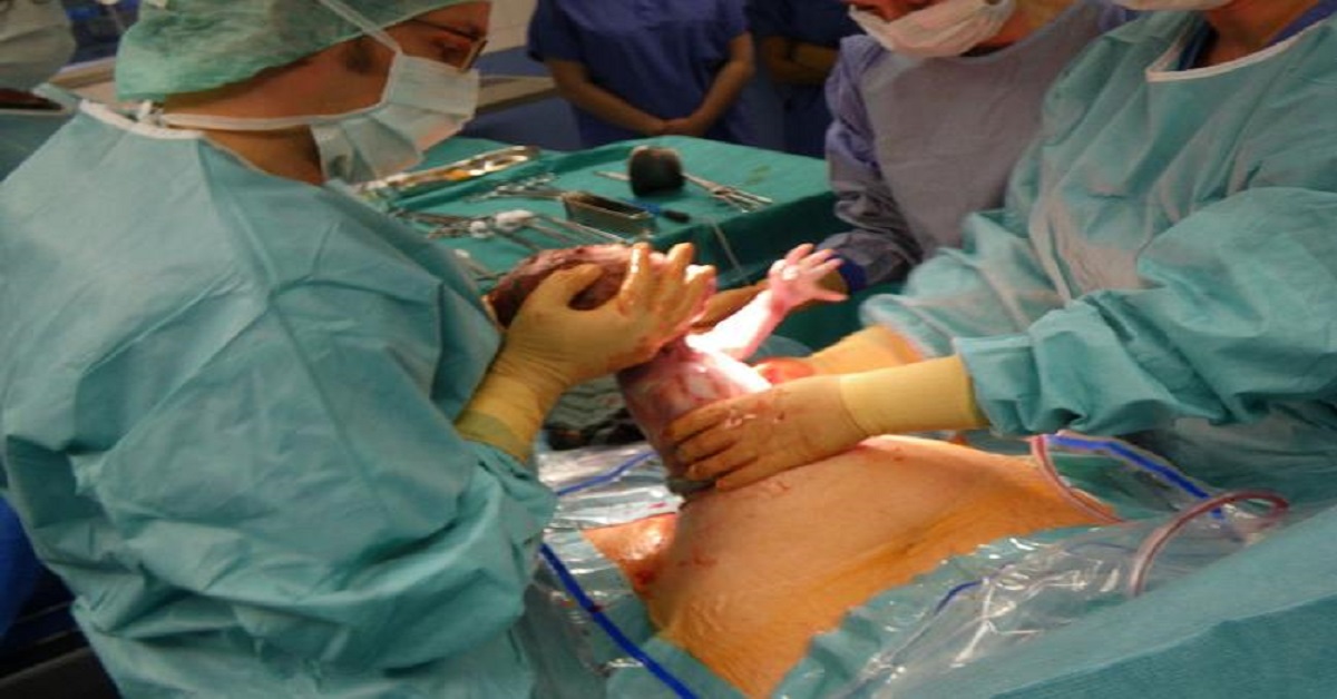 Can MBBS doctor with general Surgeon do LSCS