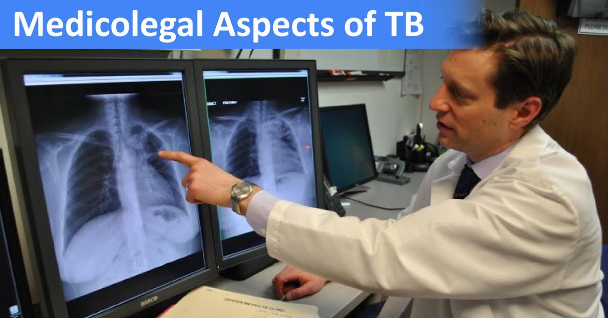 Medico Legal Aspects Of Tuberculosis