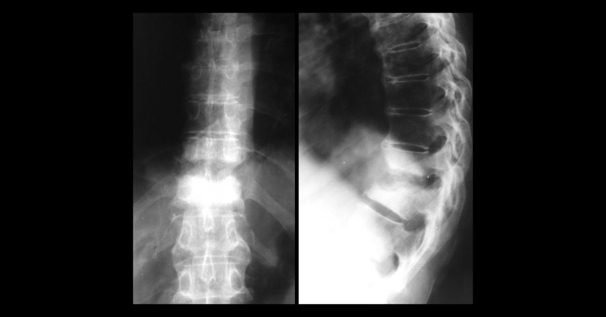 Conclude The Condition From Radiograph