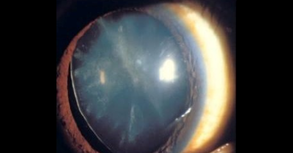 Spot This Ophthalmic Condition
