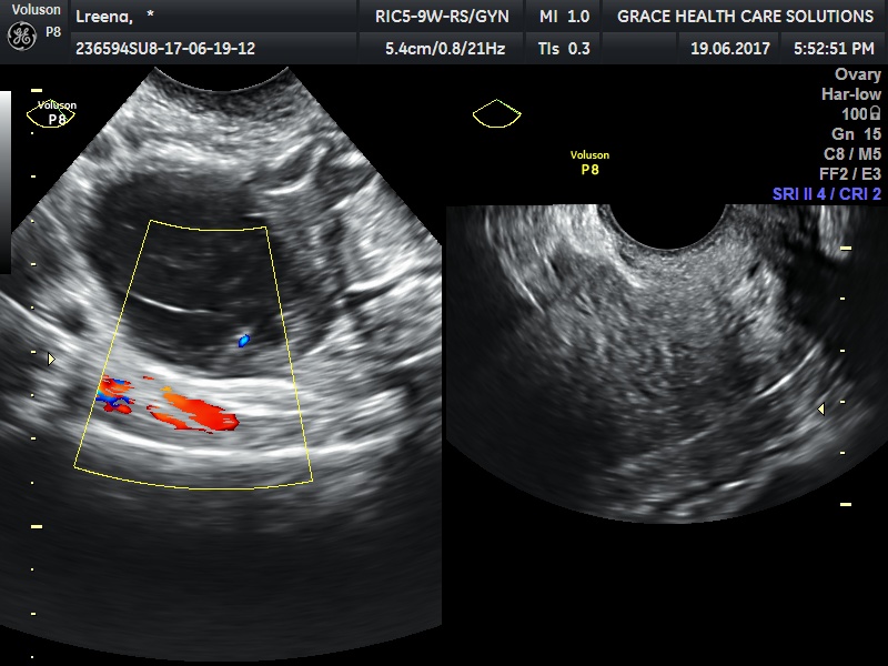 Diagnose The Cause Of Renal Colic