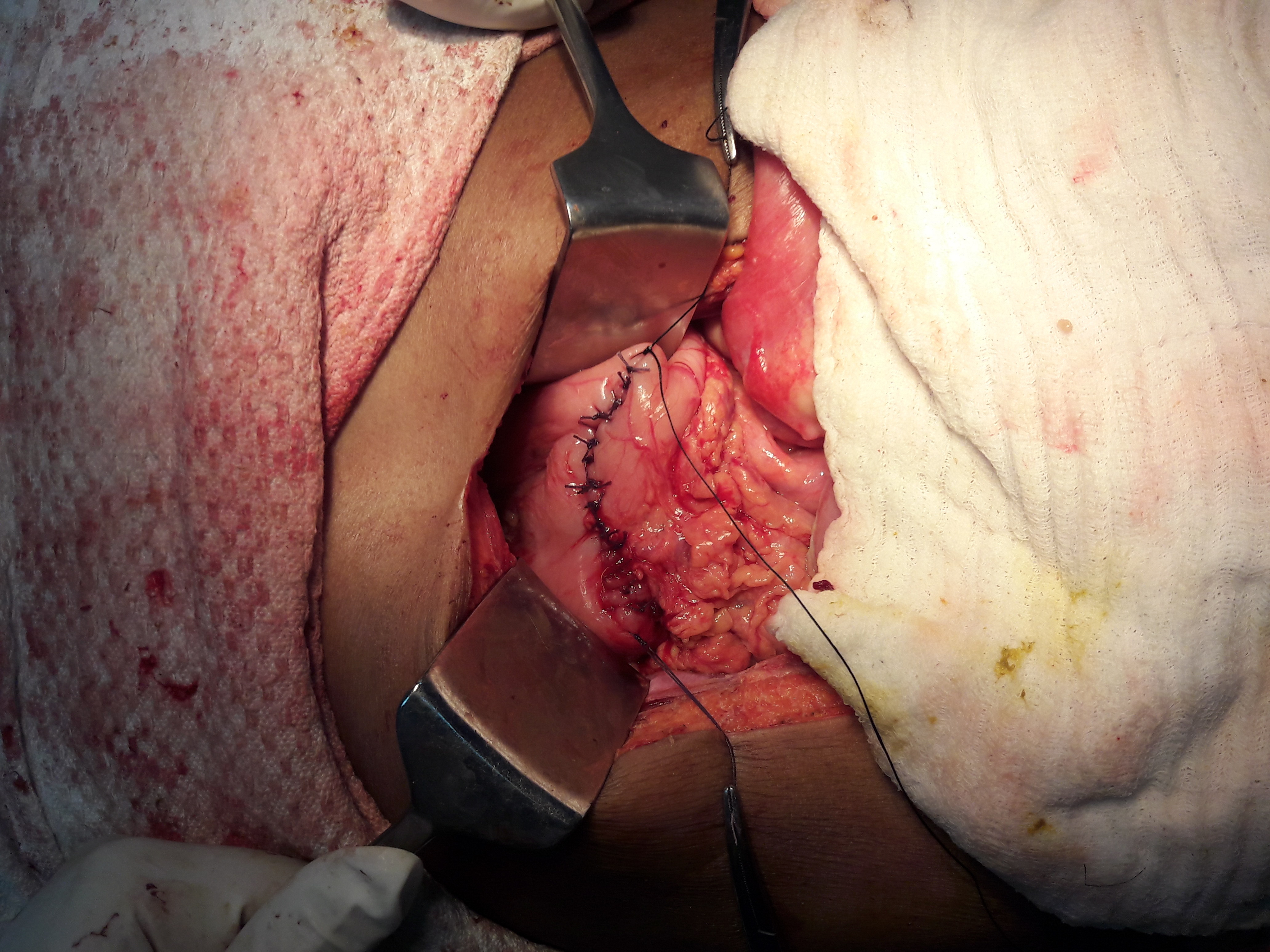 Trichobezoar With Perforation
