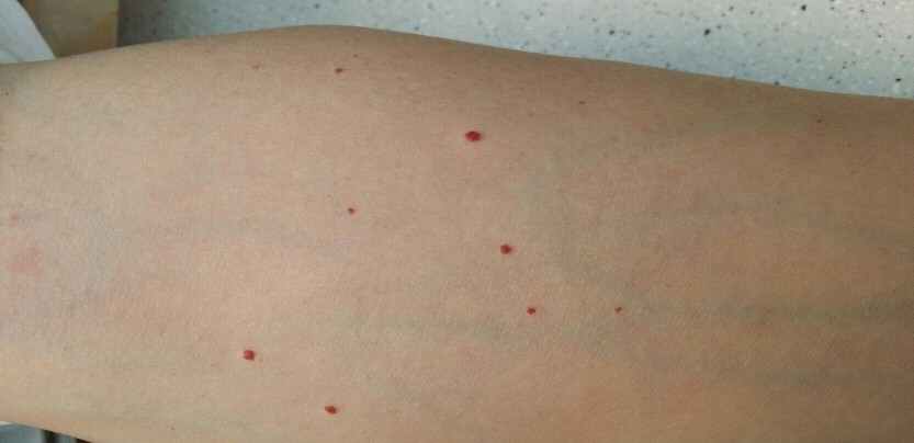 Small reddish spots on forearms