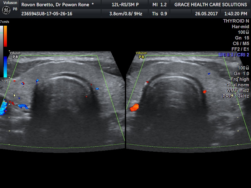 Give Differential Diagnosis For Right Submandibular Mass