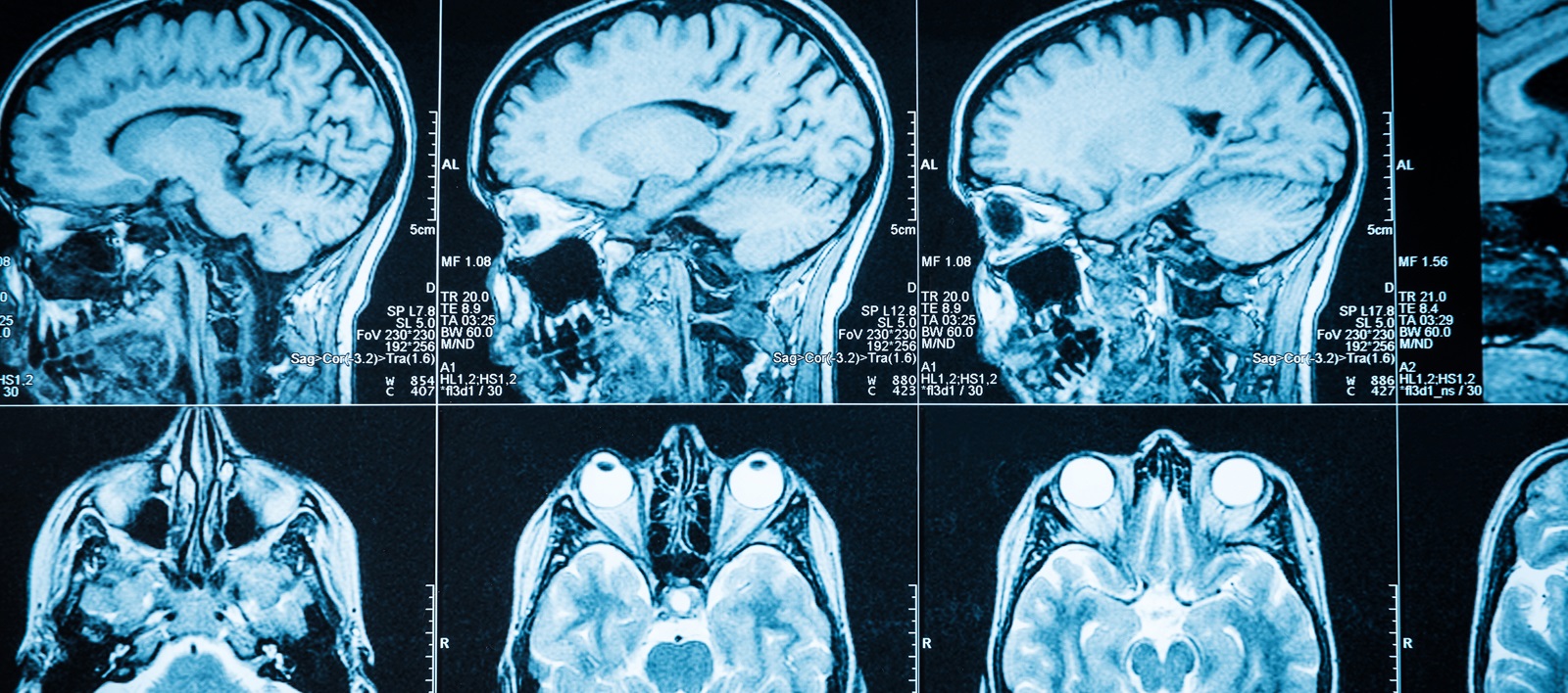 MR Imaging In Multiple Sclerosis