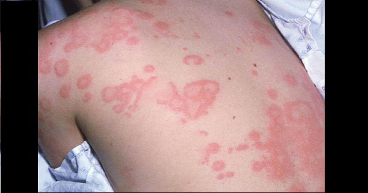 Identify The Dermal Condition