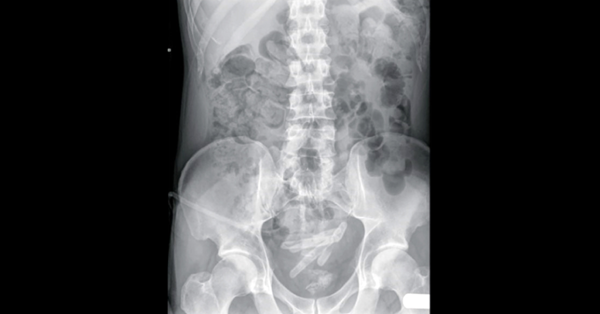 Diagnosis For Suprapubic Pain With Nausea And Vomiting