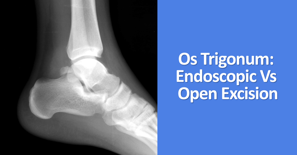 Endoscopic Vs Open Excision Of Os Trigonum