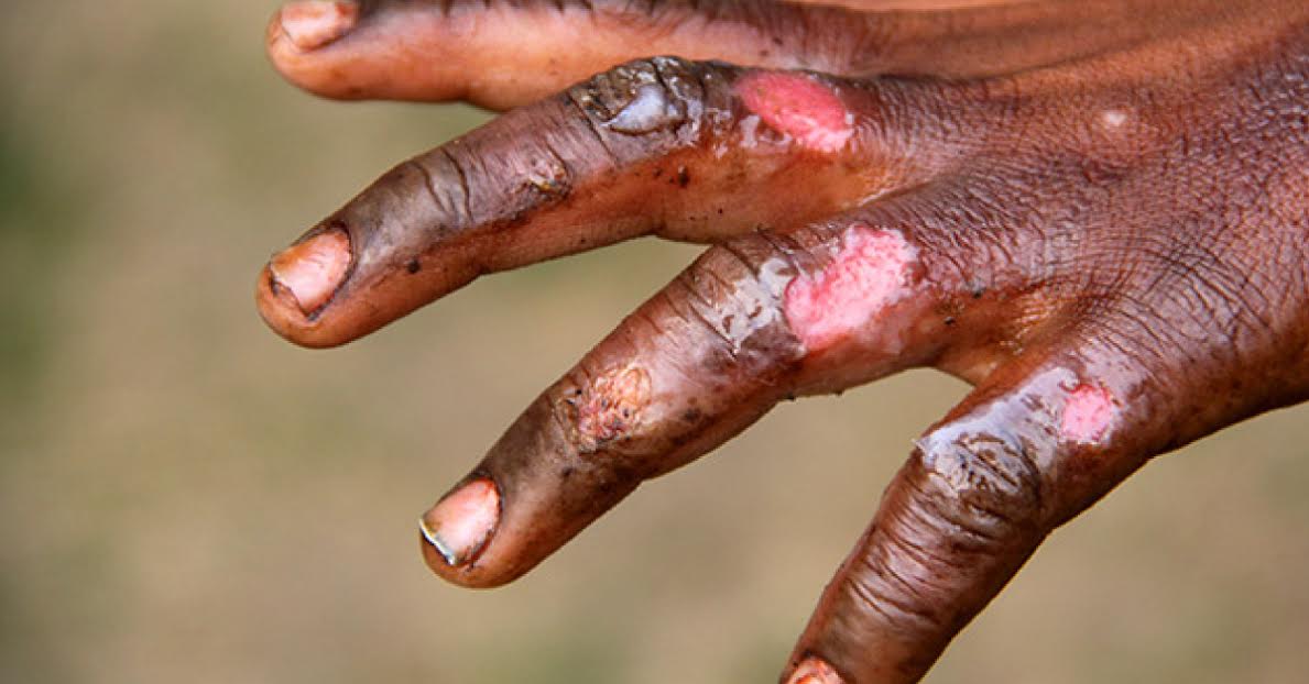 Burn Wound Infections, An Overview