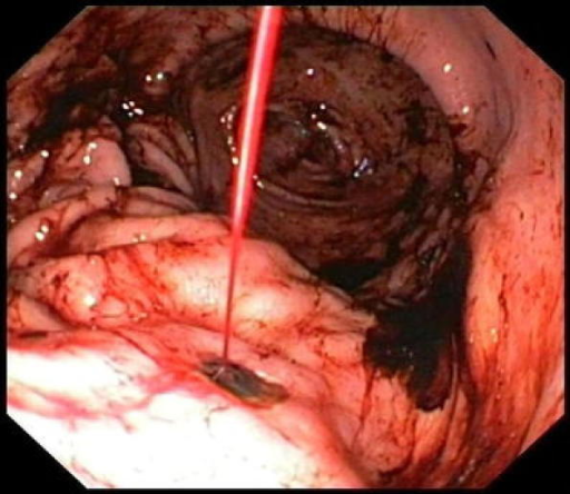 NSAIDS Use During H Pylori And Peptic Ulcer Risk