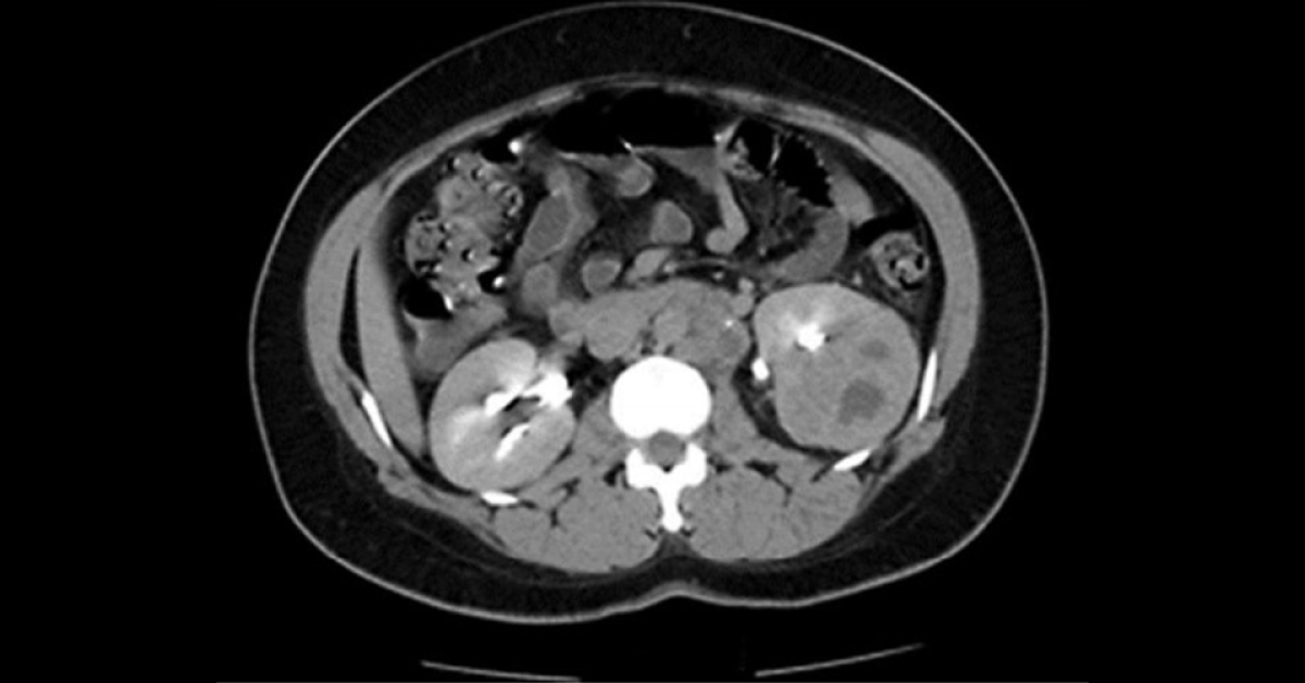 Likely Cause Of Chronic Cough And Fever
