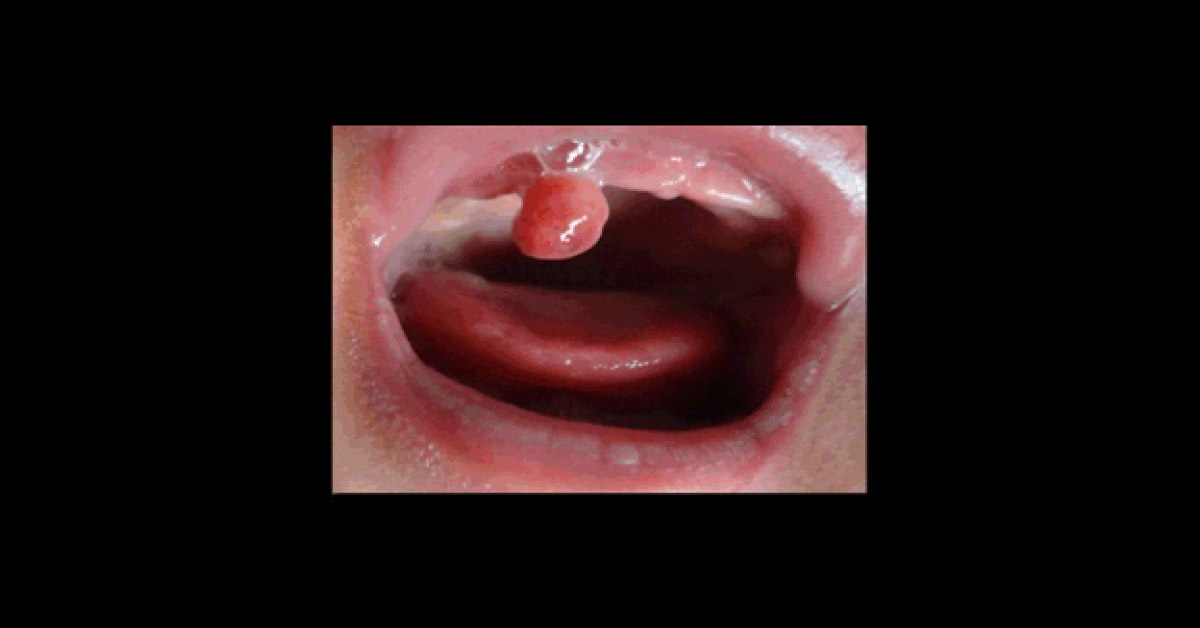 A Neonate With Exophytic Lesion In The Anterior Maxillary