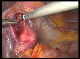Vagotomy Helps A Lot In The Result Of Bariatric Surgery