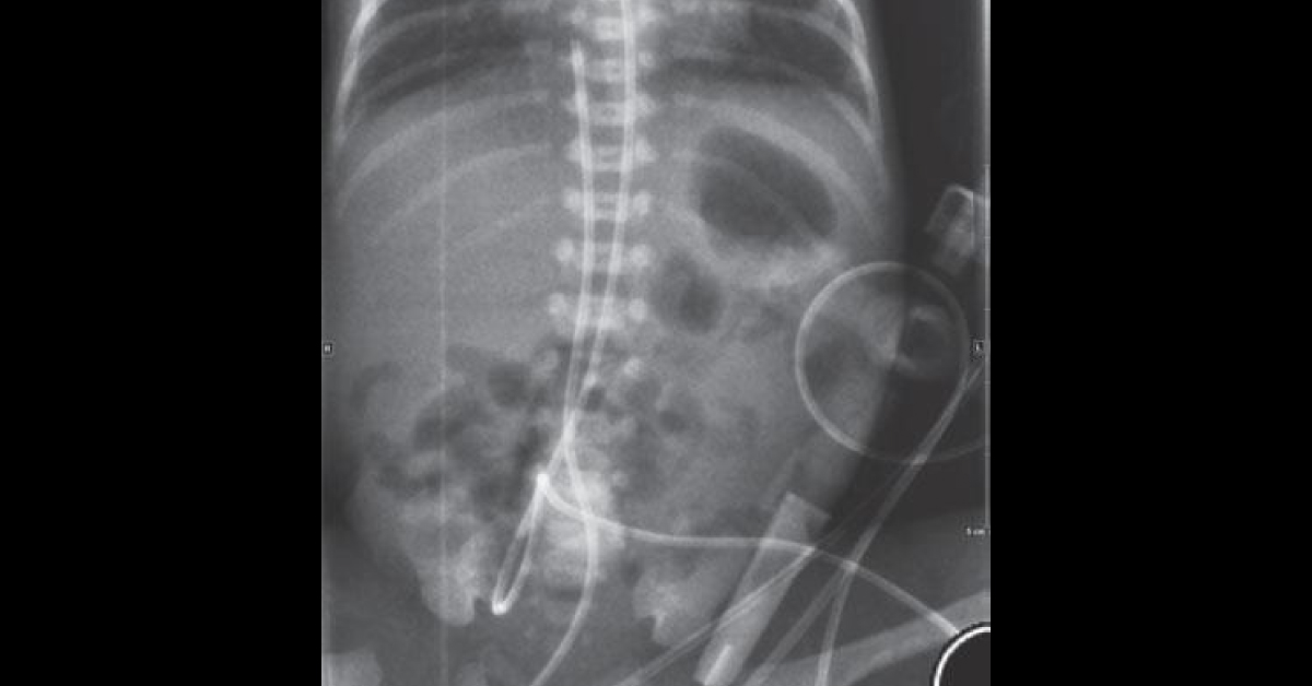Premature Neonate With Abdominal Distension