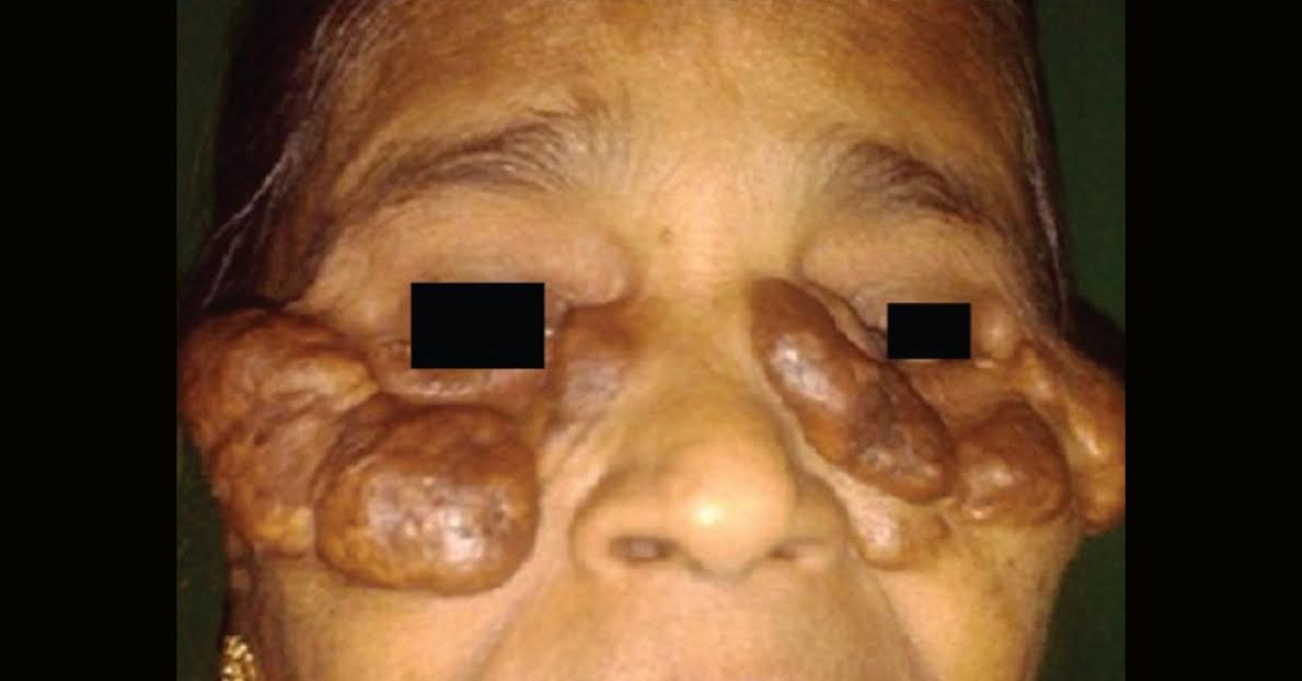 Diagnosis For Enlarged Symptomatic Lesions
