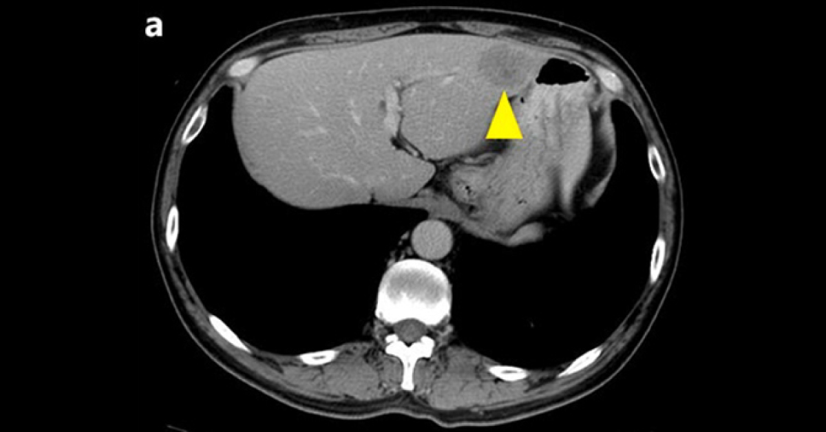 Identify The Cause Of Sudden Onset Of Hepatitis