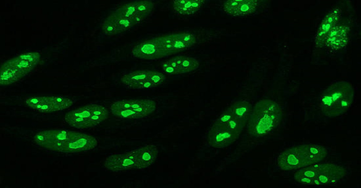 Case Of Nuclear Fluorescence In Systemic Lupus Erythematosus