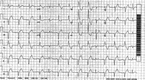 Interpret This ECG