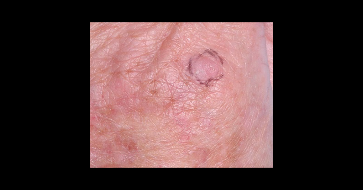 Identify The Dermal Condition