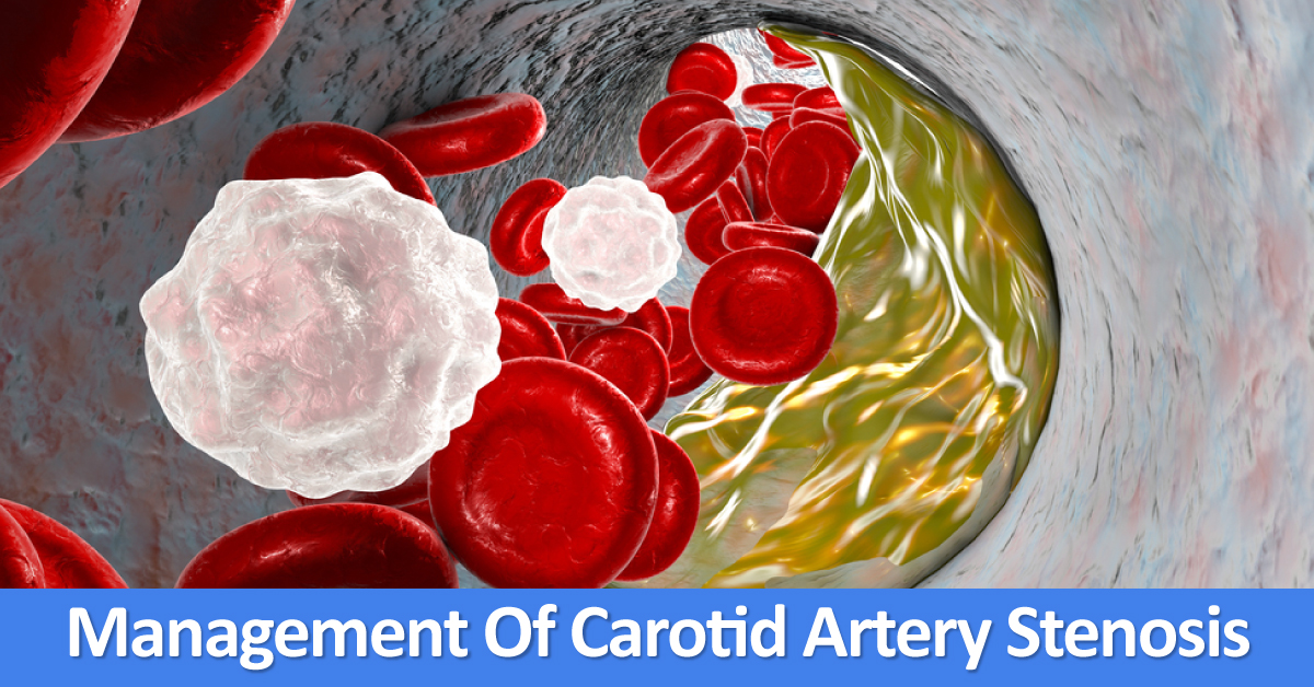 Management Of Symptomatic Carotid Artery Stenosis